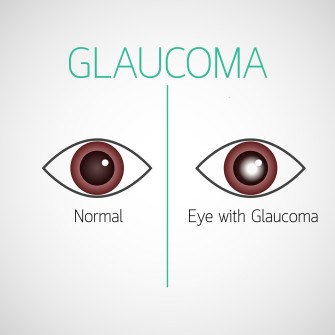 Auge mit und ohne Glaukom