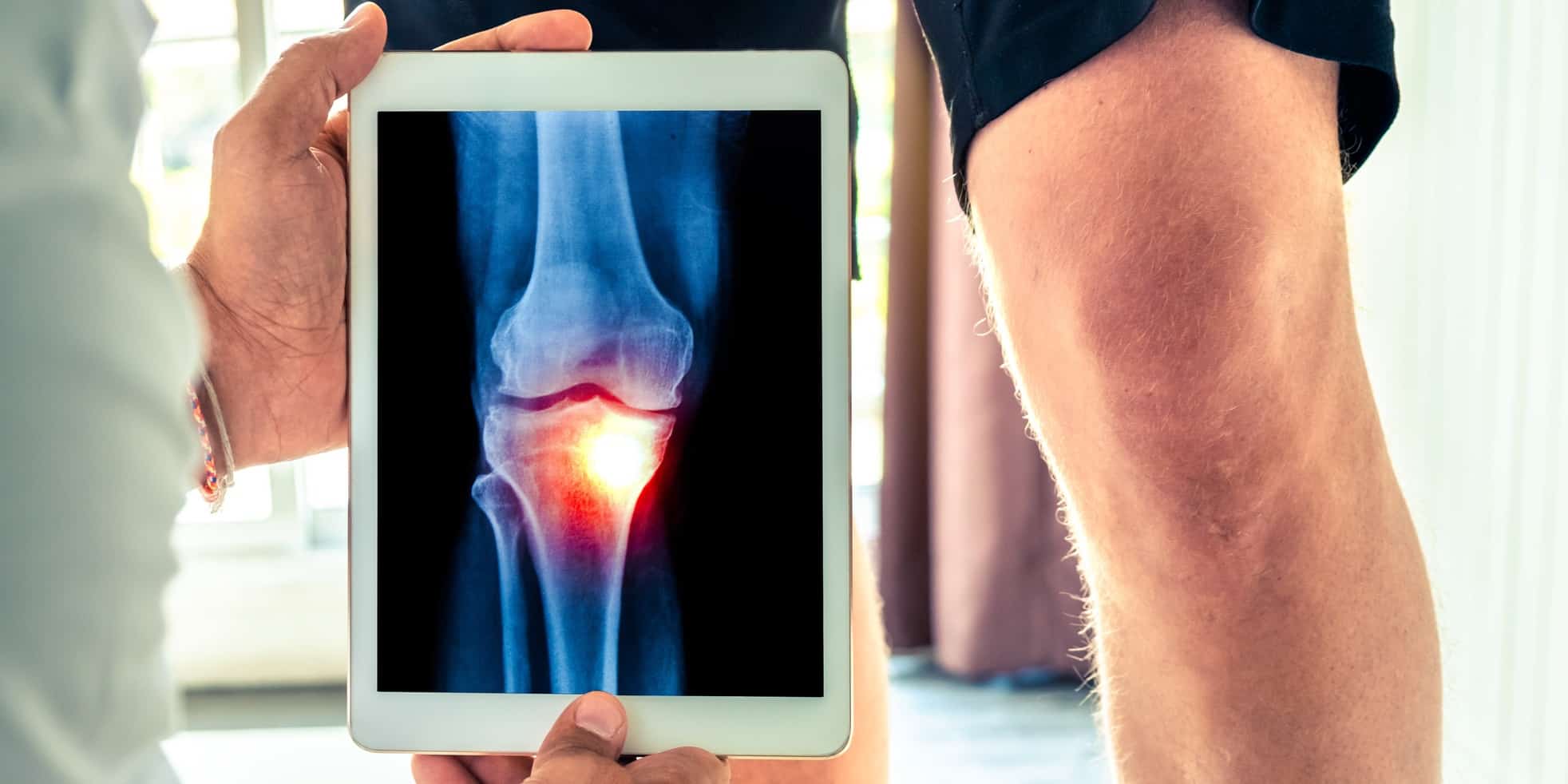 Knieschmerzen_Header Ein Arzt schaut sich ein Röntgenbild eines Knies vor seinem Patienten auf einem iPad an.